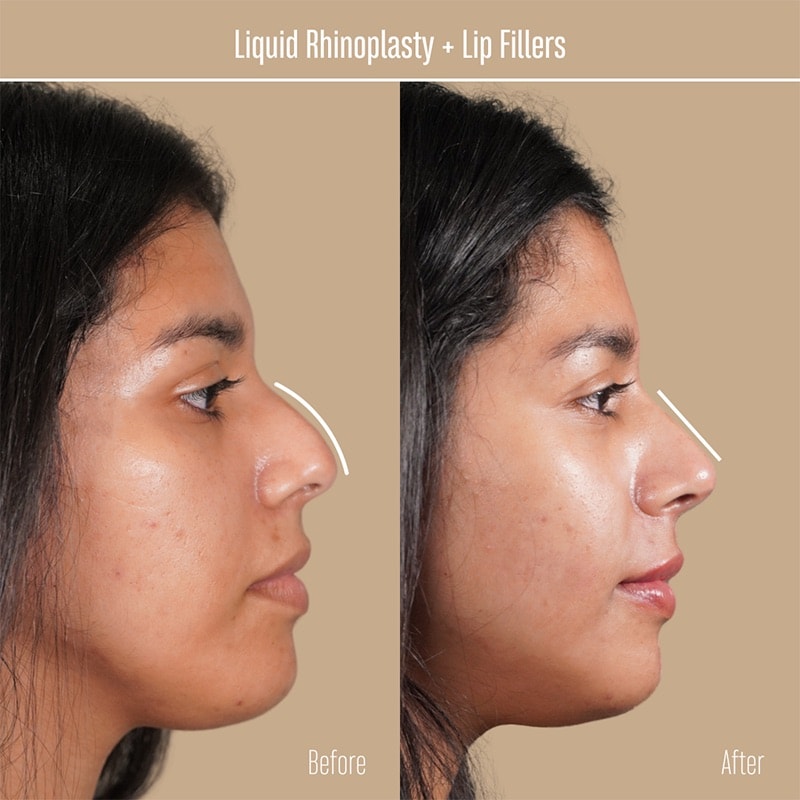 Dermal Fillers Before & After Image