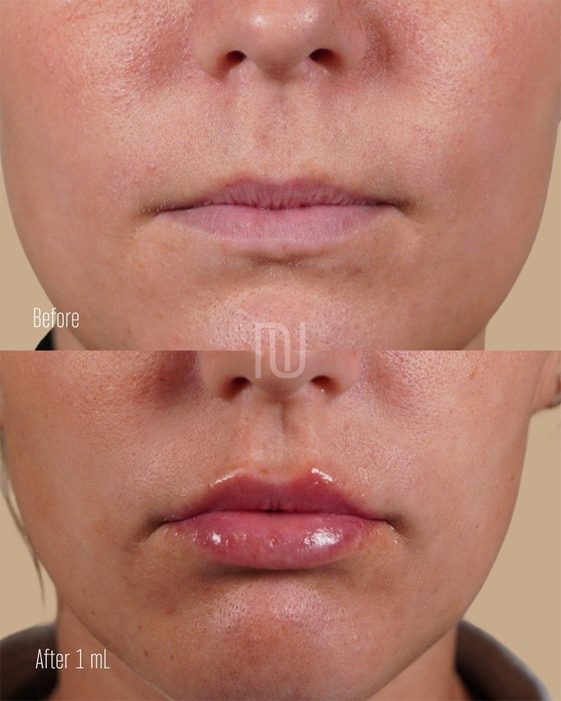 Lip Fillers Before & After Image