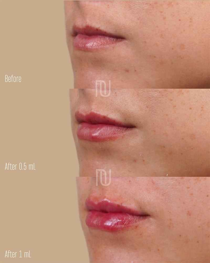 Lip Fillers Before & After Image