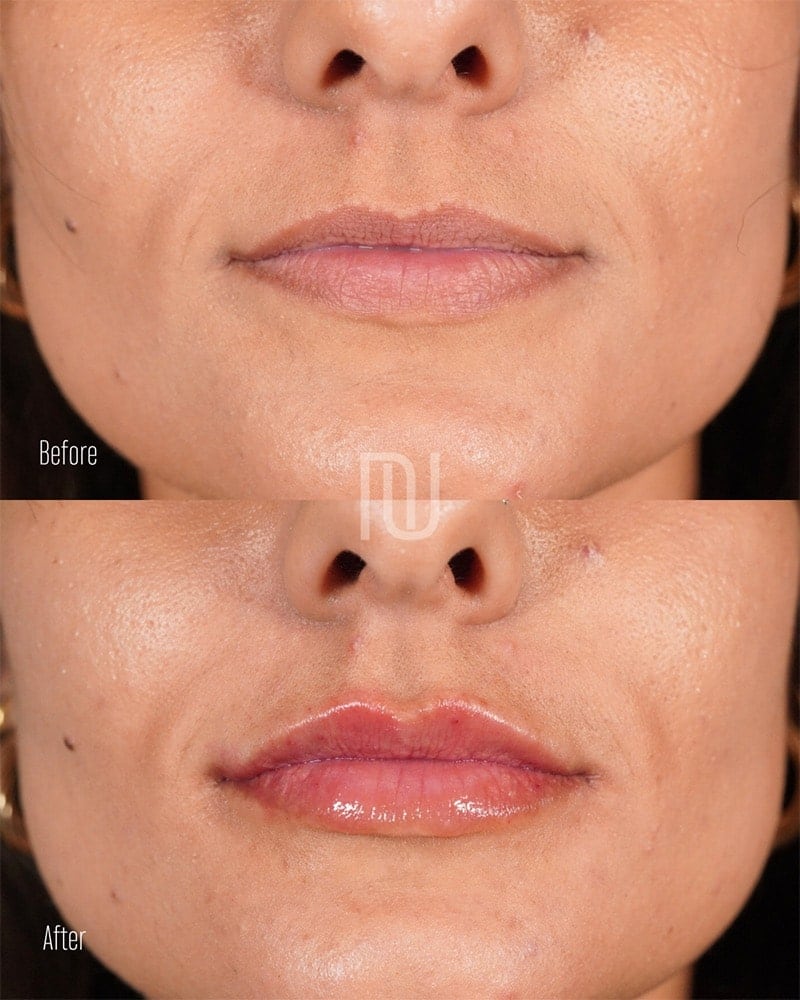 Lip Fillers Before & After Image