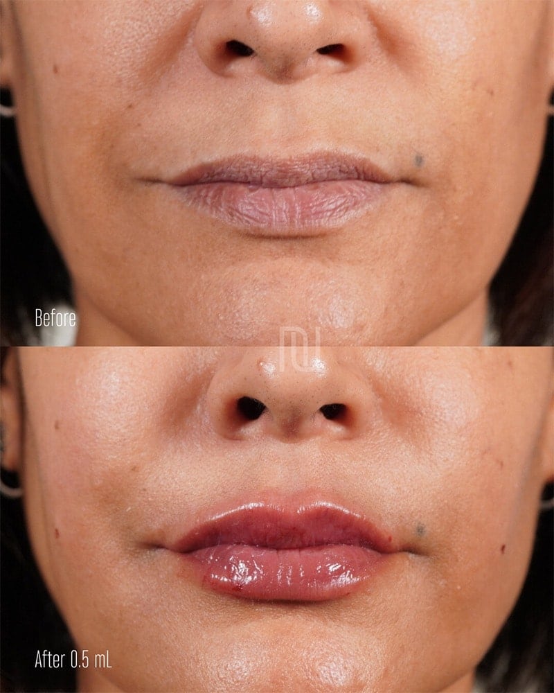 Lip Fillers Before & After Image