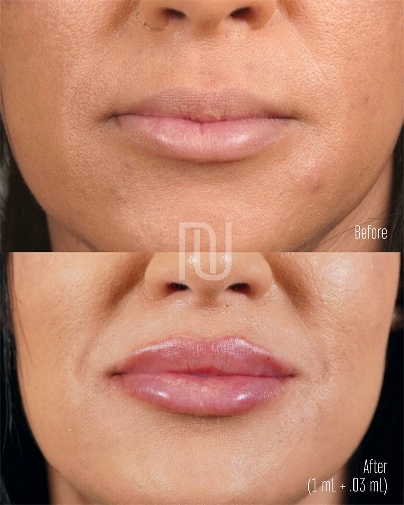 Lip Fillers Before & After Image