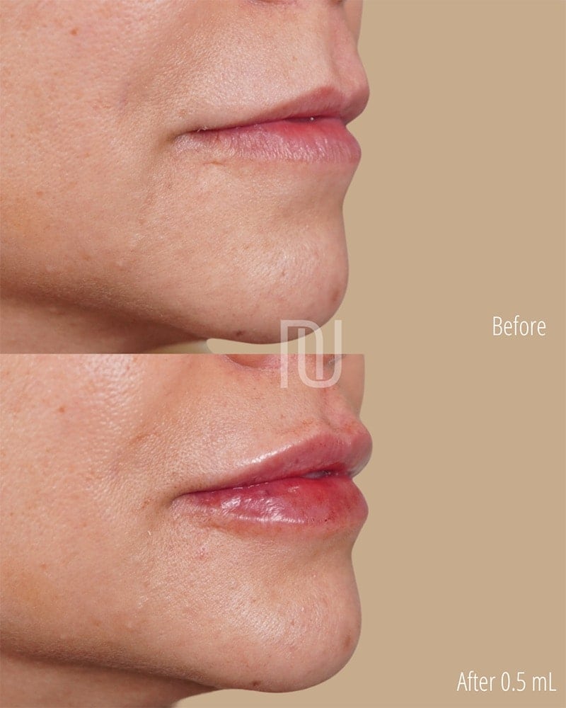 Lip Fillers Before & After Image