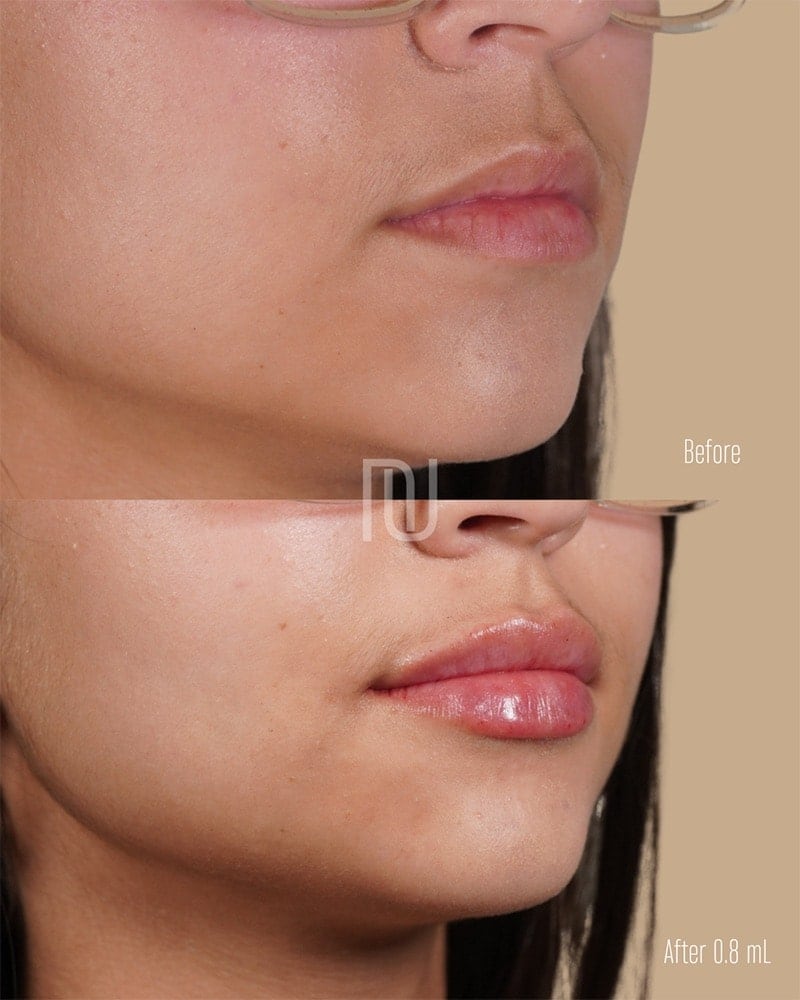 Lip Fillers Before & After Image