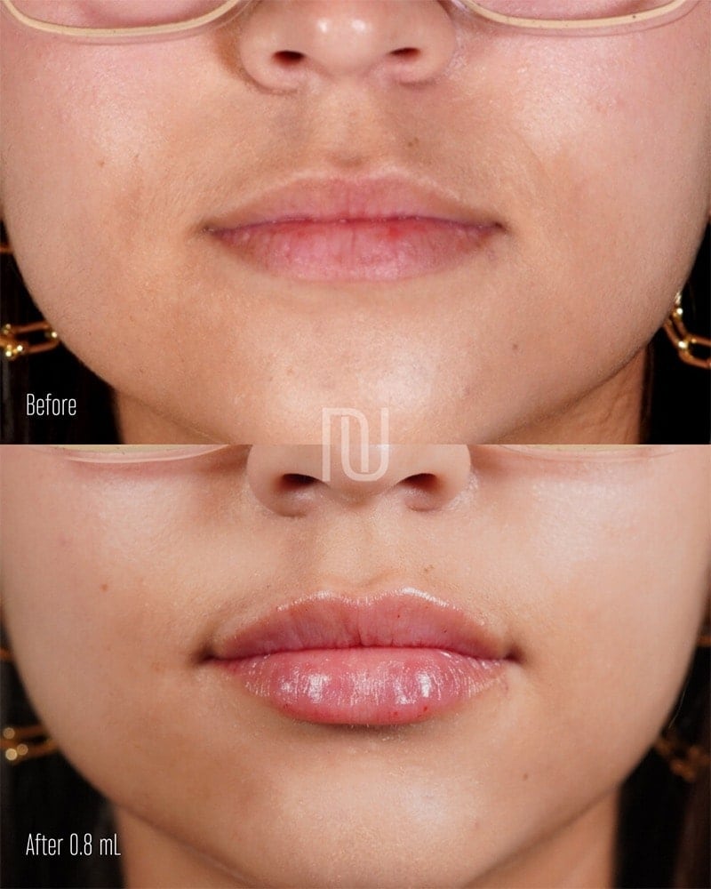 Lip Fillers Before & After Image