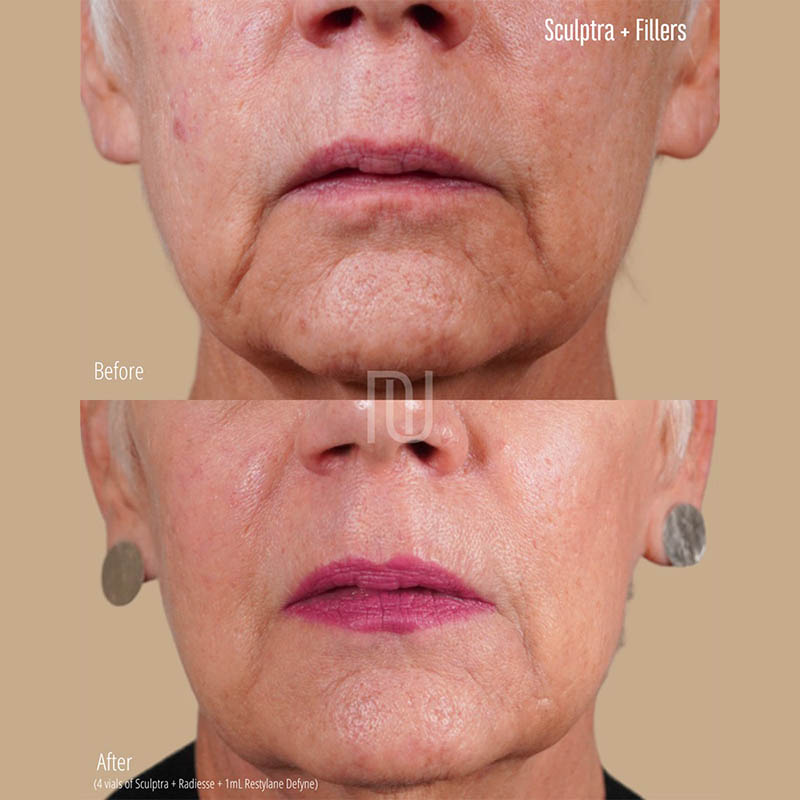 Sculptra Before & After Image