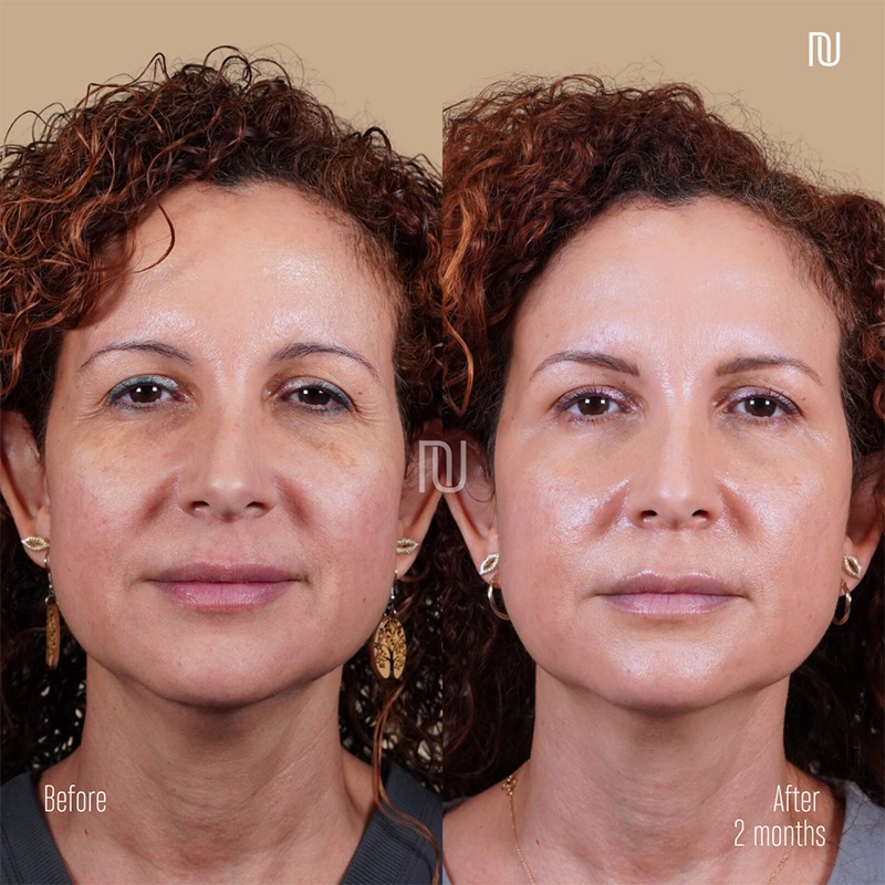 Sculptra Before & After Image