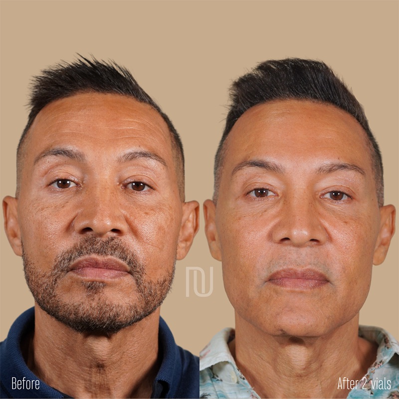 Sculptra Before & After Image