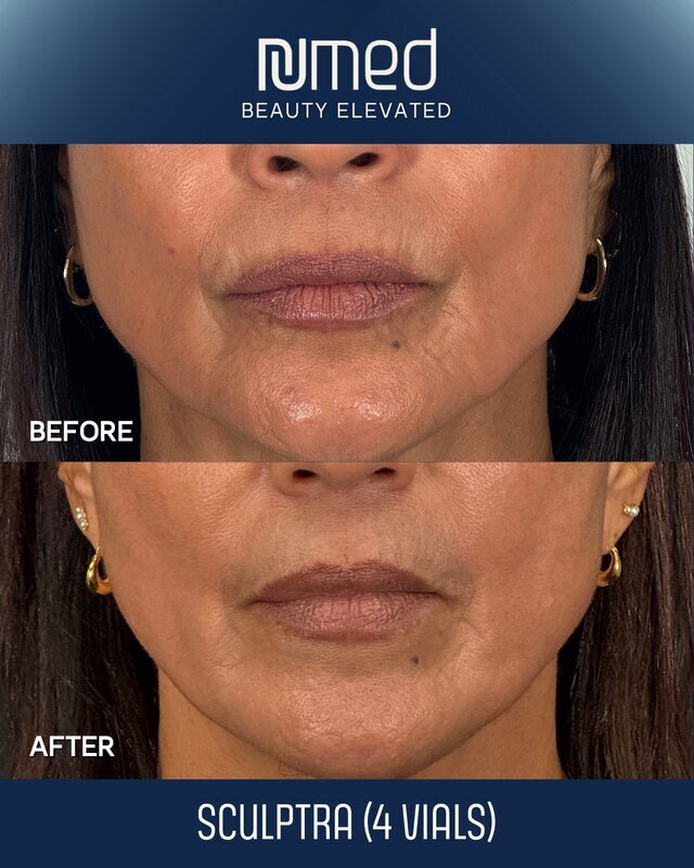 Sculptra Before & After Image
