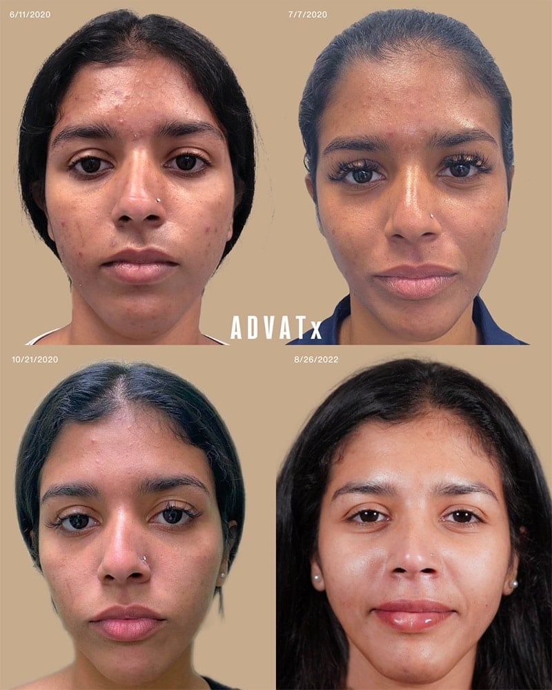 ADVATx Laser Before & After Image