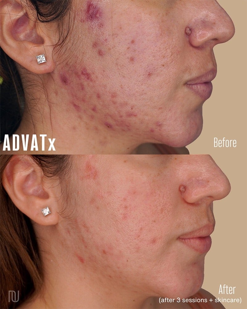 ADVATx Laser Before & After Image