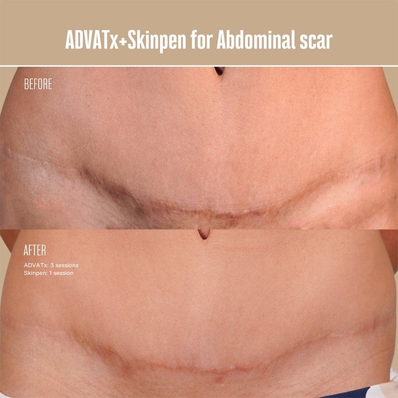 ADVATx Laser Before & After Image