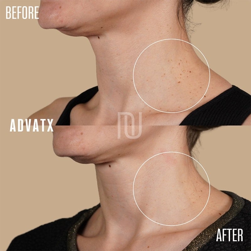 ADVATx Laser Before & After Image