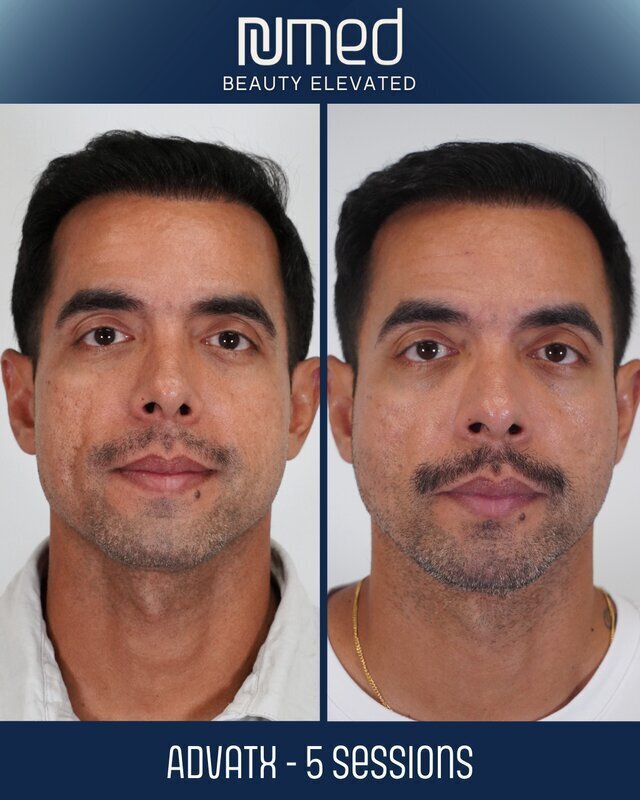 ADVATx Laser Before & After Image