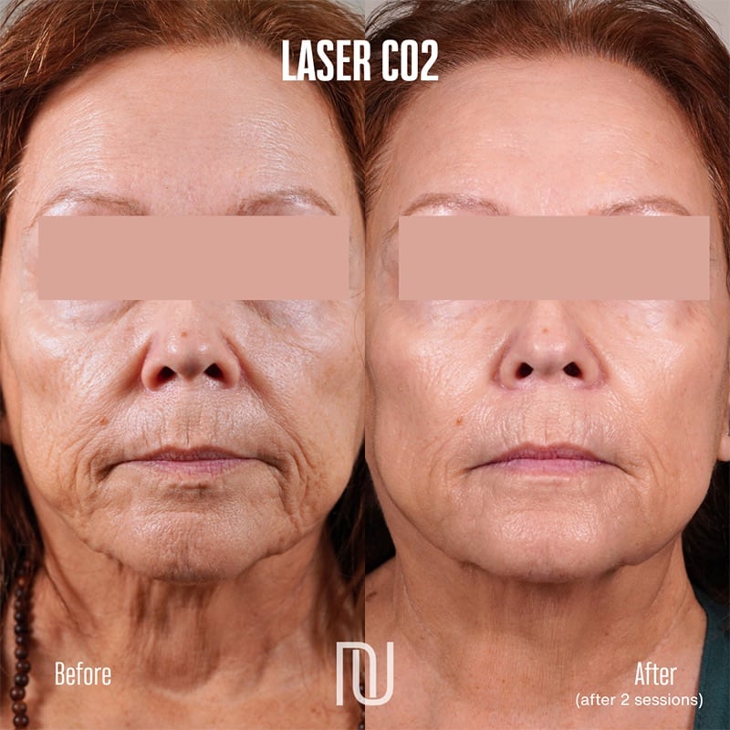 Fractional CO2 Laser Before & After Image