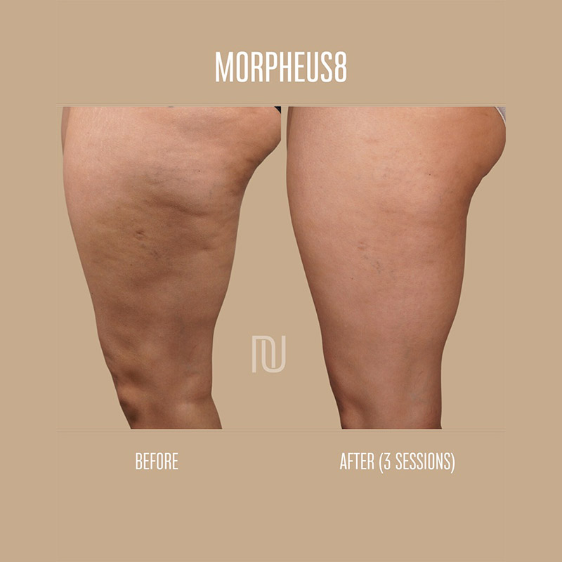 Morpheus8 Before & After Image