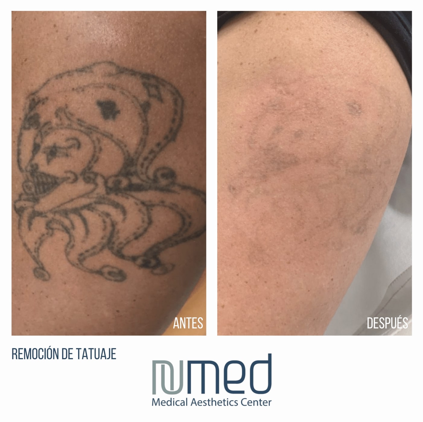 Tattoo Removal Before & After Image