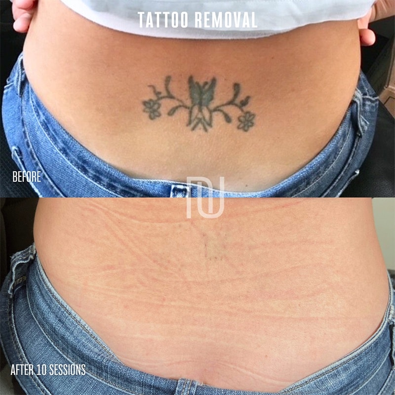 Tattoo Removal Before & After Image