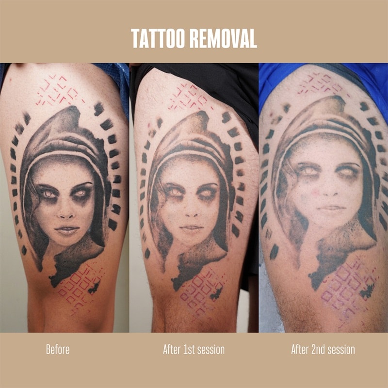 Tattoo Removal Before & After Image