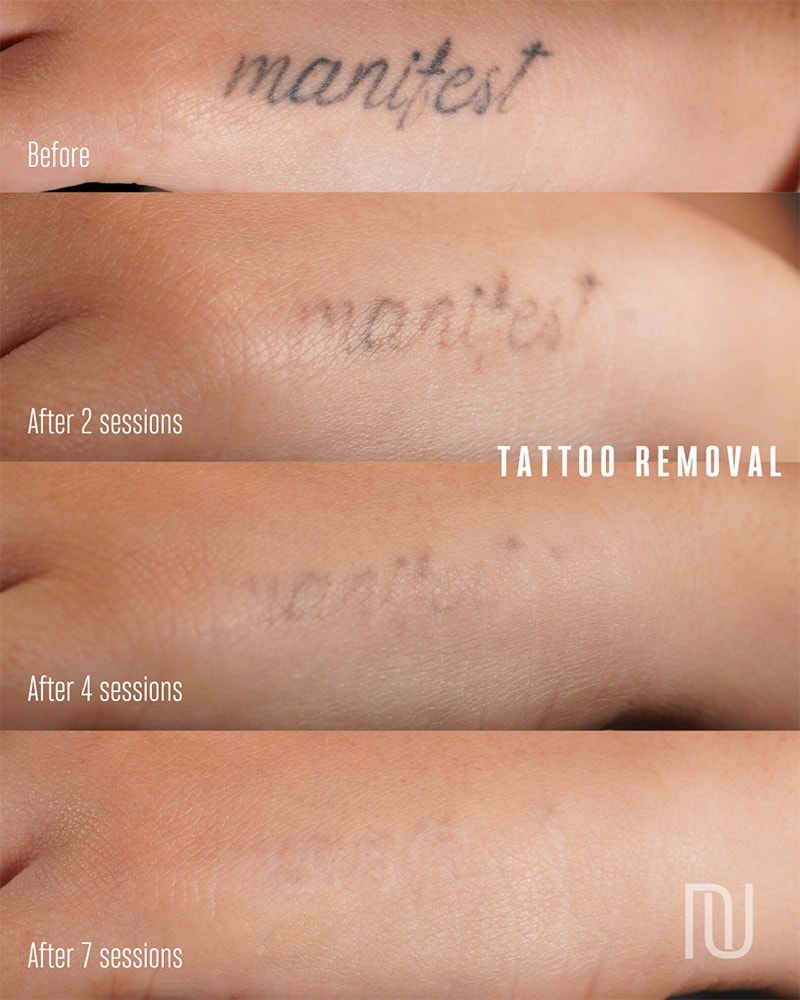 Tattoo Removal Before & After Image