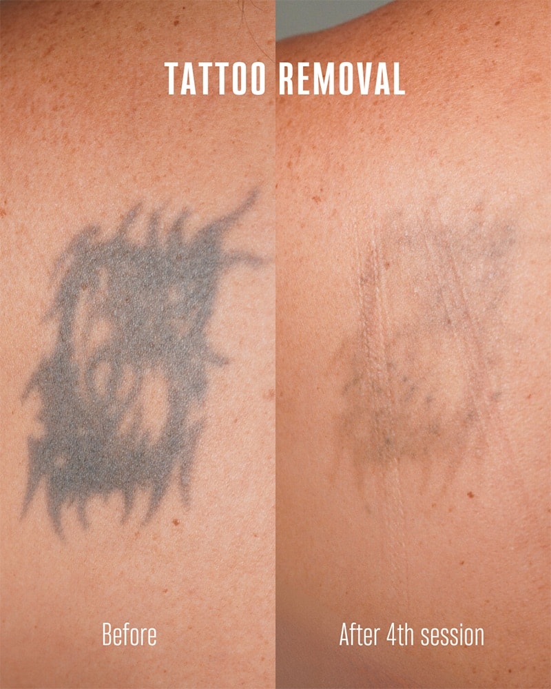 Tattoo Removal Before & After Image