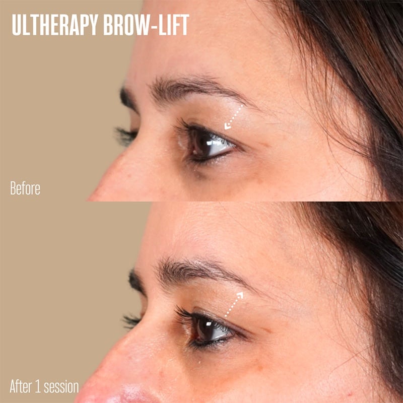 Ultherapy Before & After Image