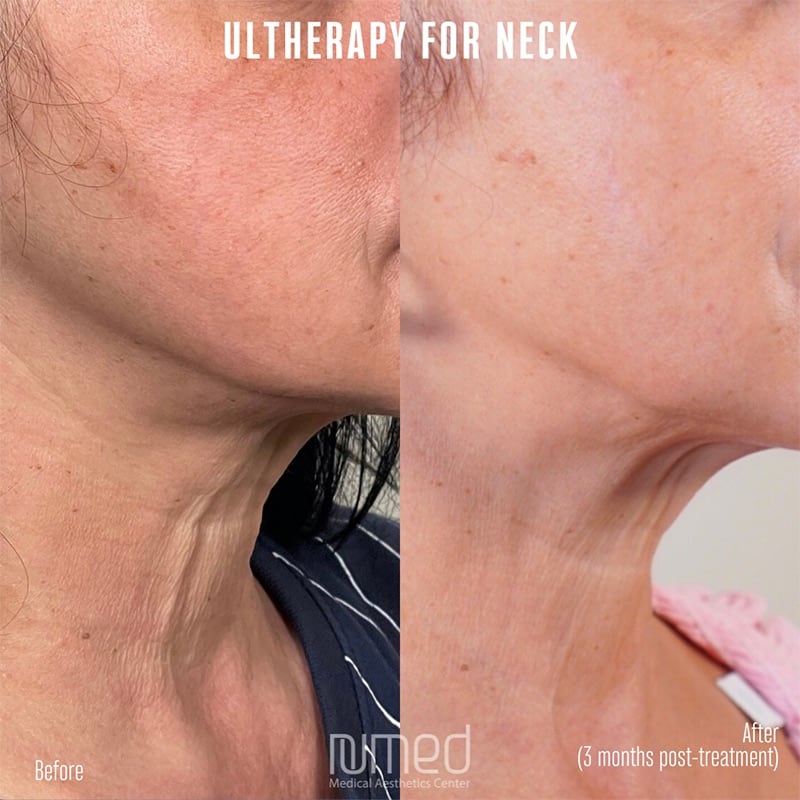 Ultherapy Before & After Image