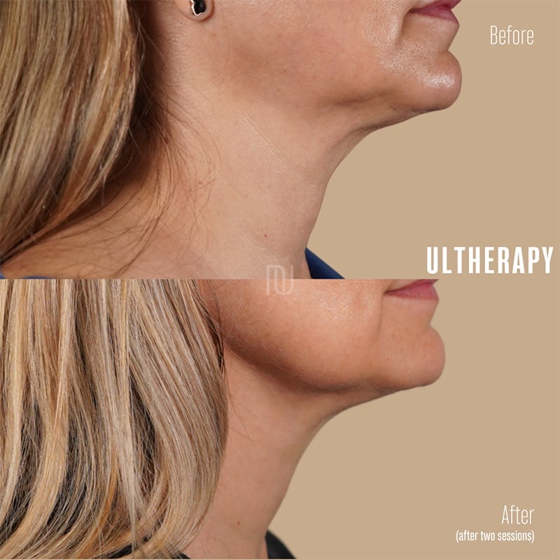 Ultherapy Before & After Image