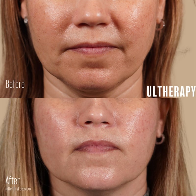 Ultherapy Before & After Image