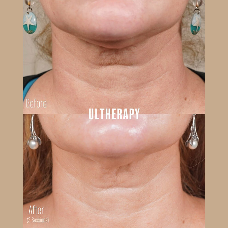 Ultherapy Before & After Image