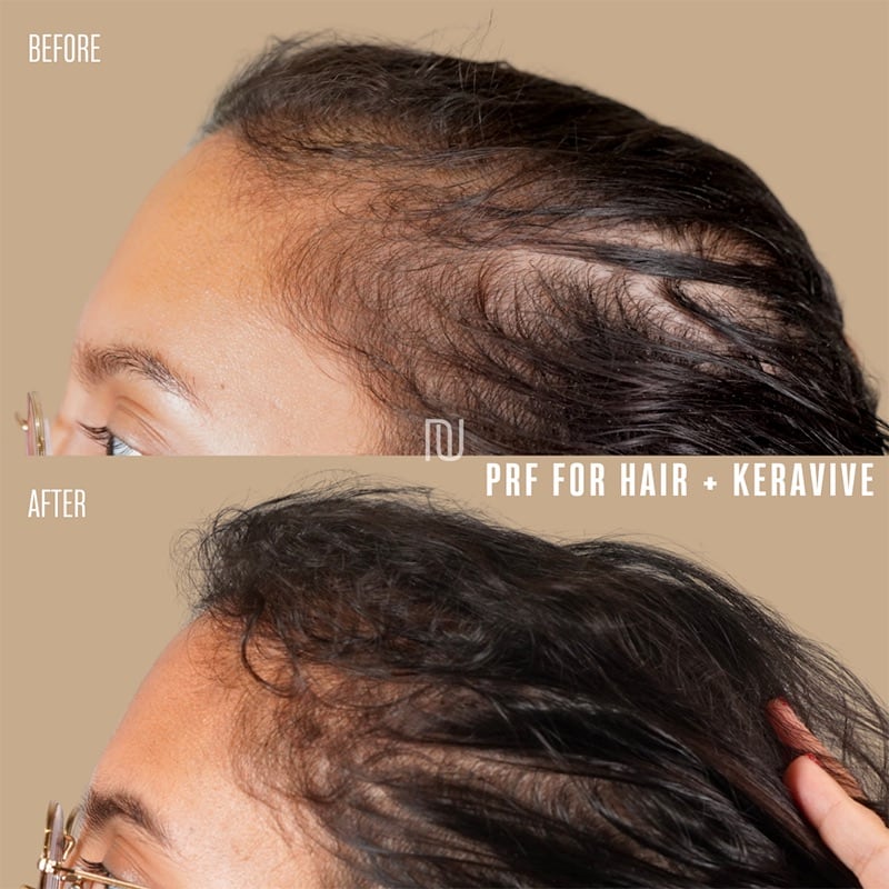 PRP/PRF Hair Restoration Before & After Image