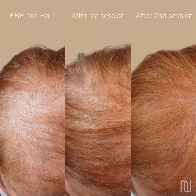 PRP/PRF Hair Restoration Before & After Image