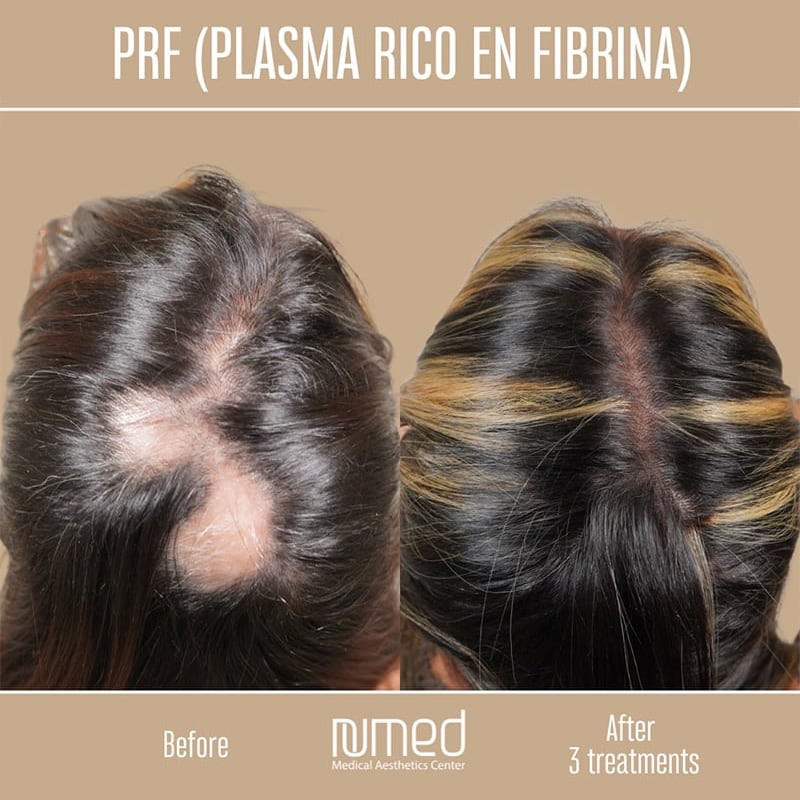 PRP/PRF Hair Restoration Before & After Image