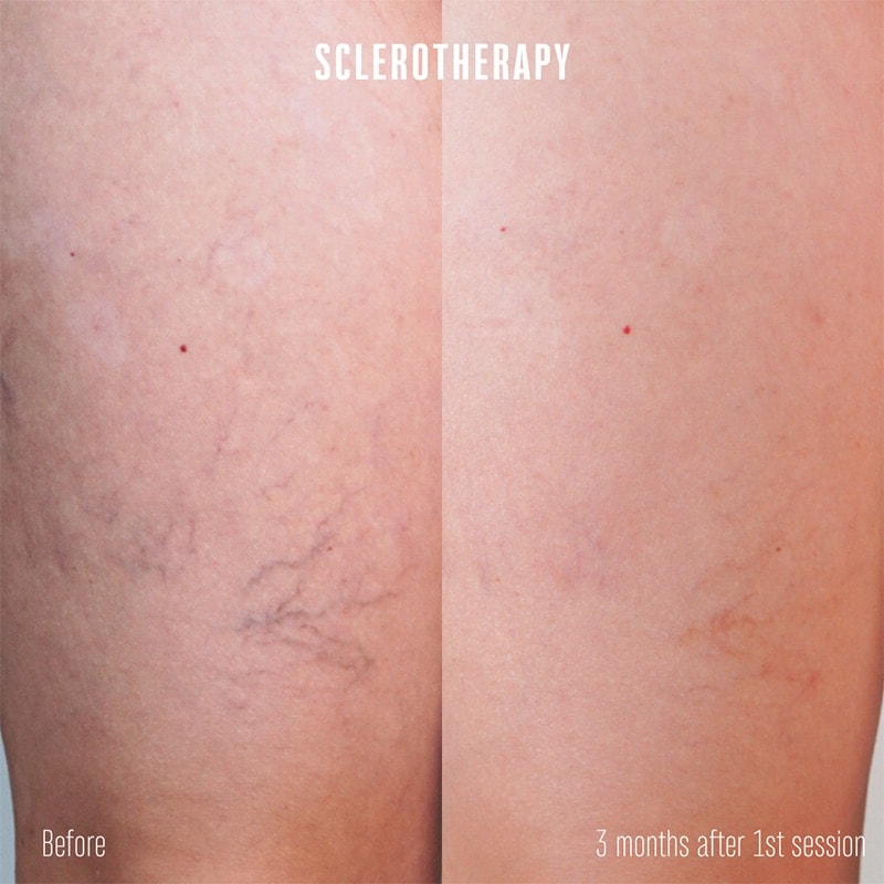 Sclerotherapy Before & After Image