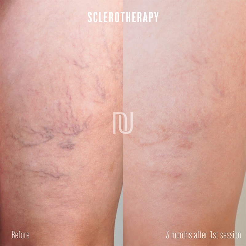 Sclerotherapy Before & After Image