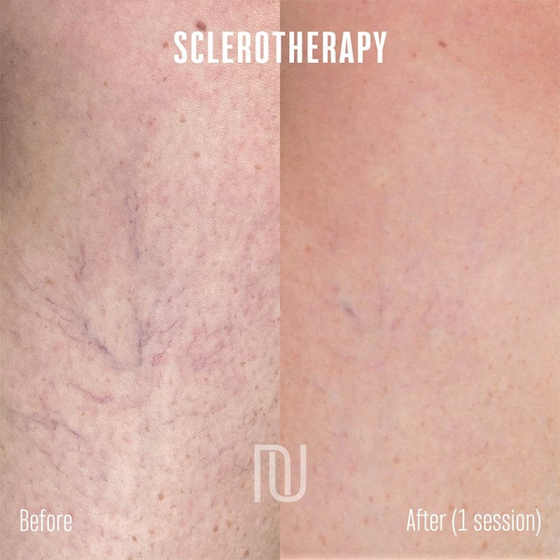 Sclerotherapy Before & After Image