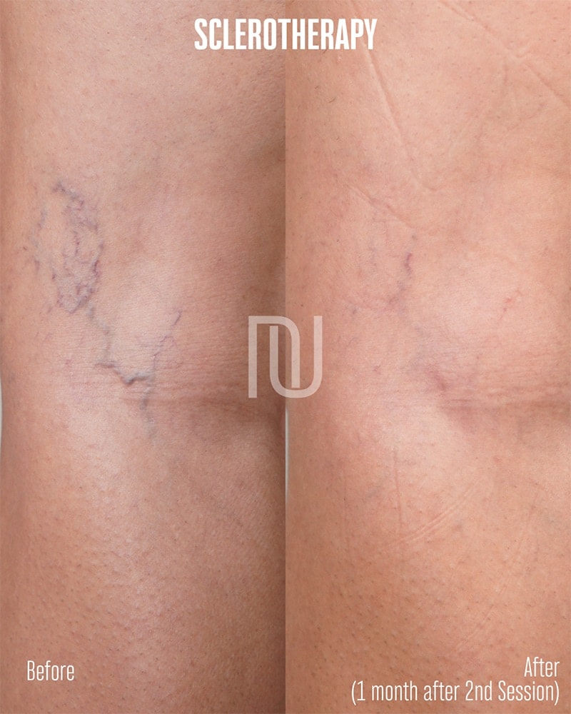 Sclerotherapy Before & After Image