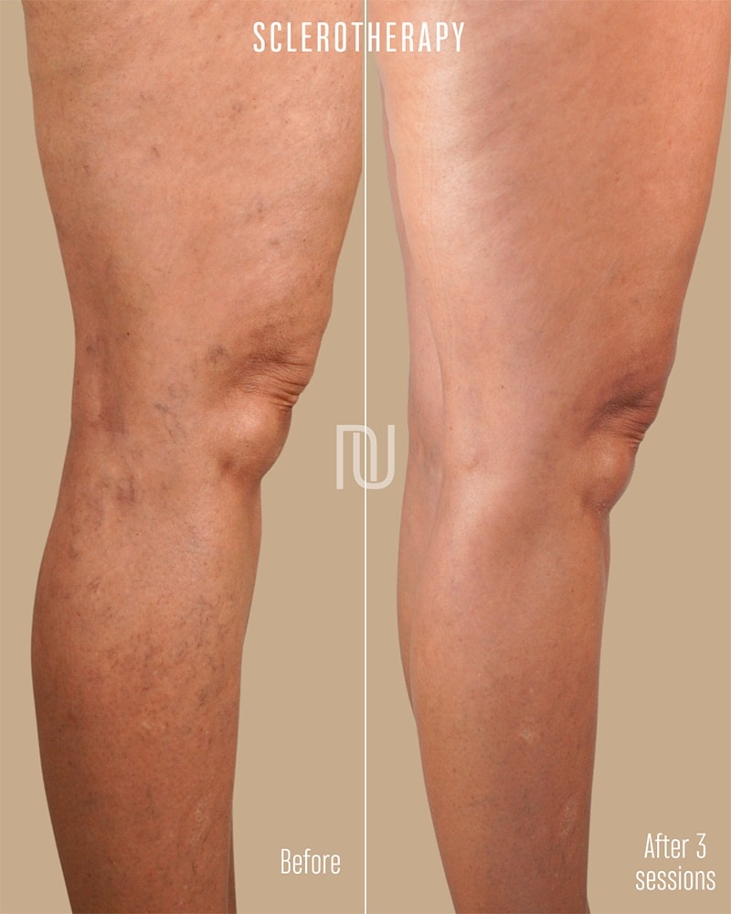 Sclerotherapy Before & After Image