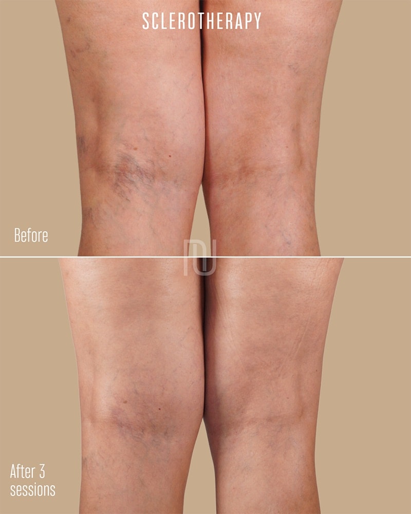 Sclerotherapy Before & After Image