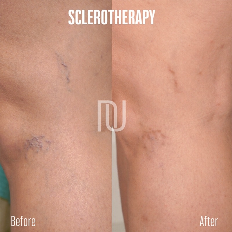 Sclerotherapy Before & After Image